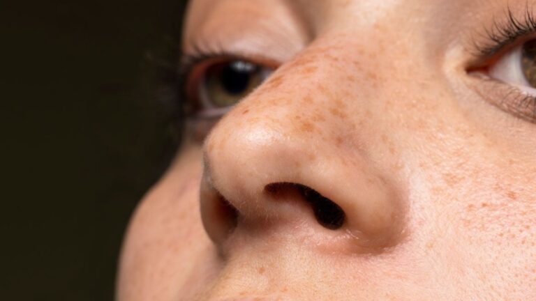 Гиперпигментация - Почему она появляется и как реагировать?