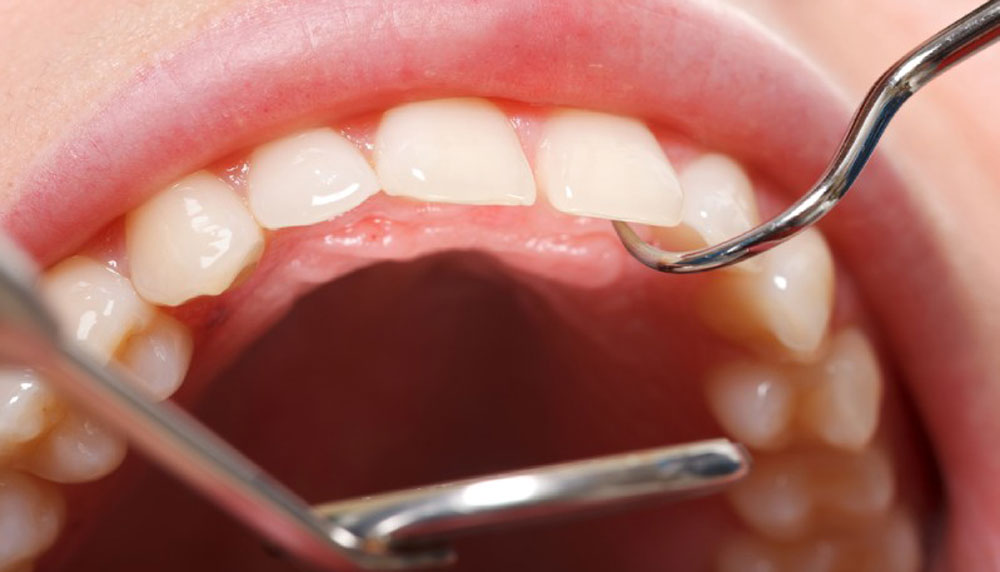 Ученые создали гель, восстанавливающий зубную эмаль без фтора