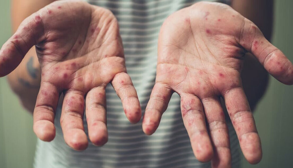 В Киевской области зафиксировали вспышку вируса Коксаки: как обезопасить себя