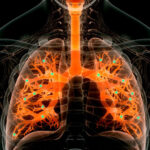 Почему людям, живущим с ВИЧ, необходимо проходить тестирование на туберкулез