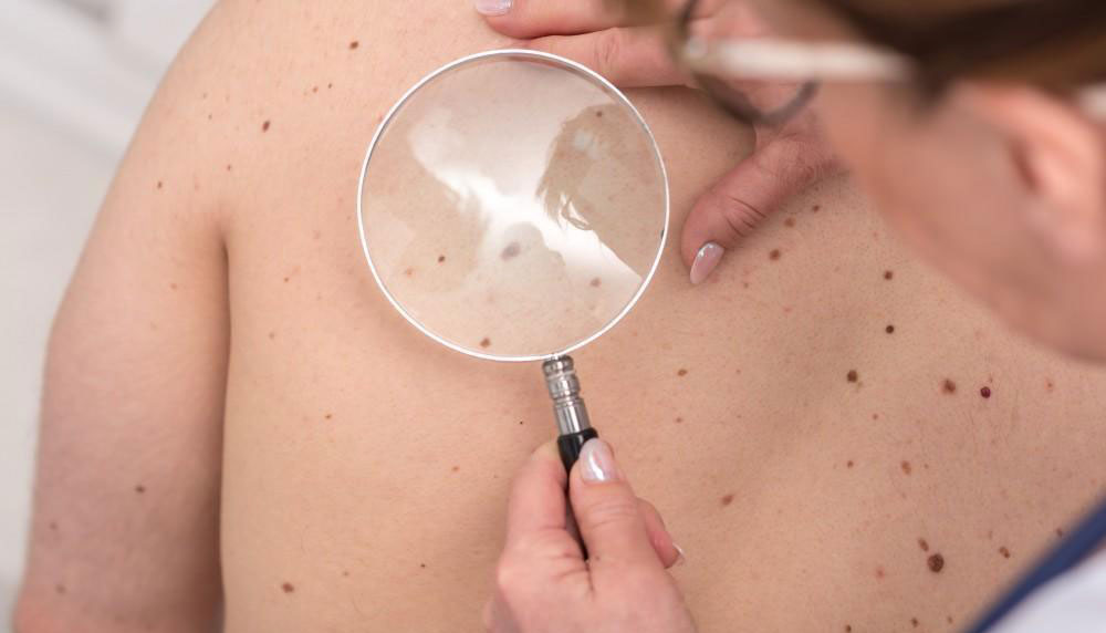 Украина закупила инновационный препарат для лечения больных меланомой