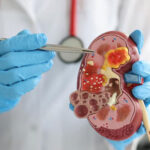 Жизнь в жарких и влажных регионах может увеличить риск почечной недостаточности.