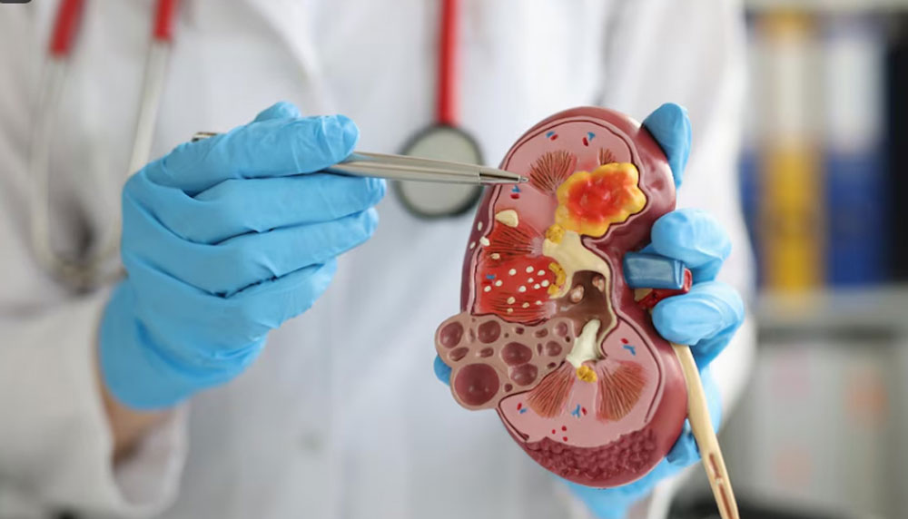 Жизнь в жарких и влажных регионах может увеличить риск почечной недостаточности.