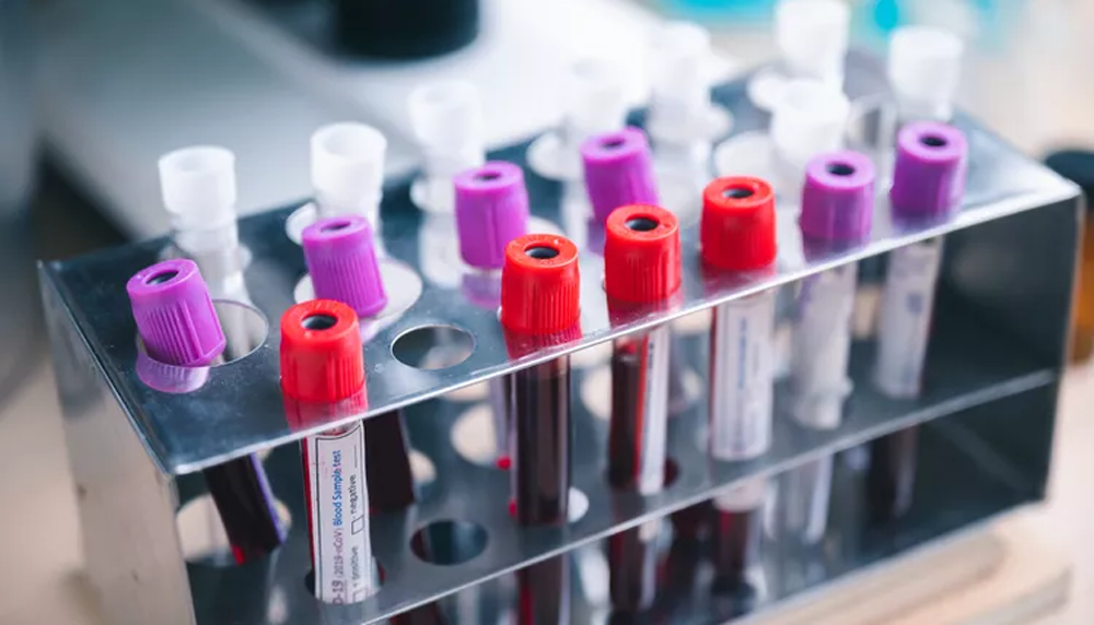 Врачи объяснили, когда необходимо сдать анализ на ВИЧ