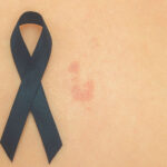 Вакцина от Moderna и Merck показала свою эффективность против рака кожи