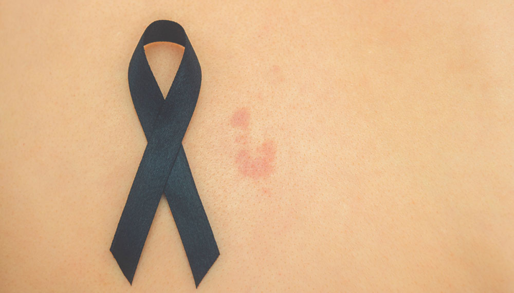 Вакцина от Moderna и Merck показала свою эффективность против рака кожи