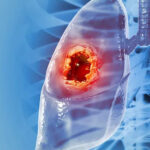 Ученые предложили новый подход к лечению рака легких