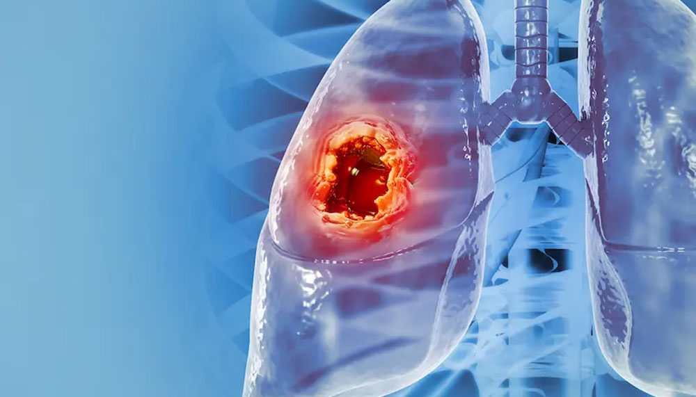 Ученые предложили новый подход к лечению рака легких