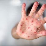 С 2026 года дети будут получать полную защиту от кори в более раннем возрасте