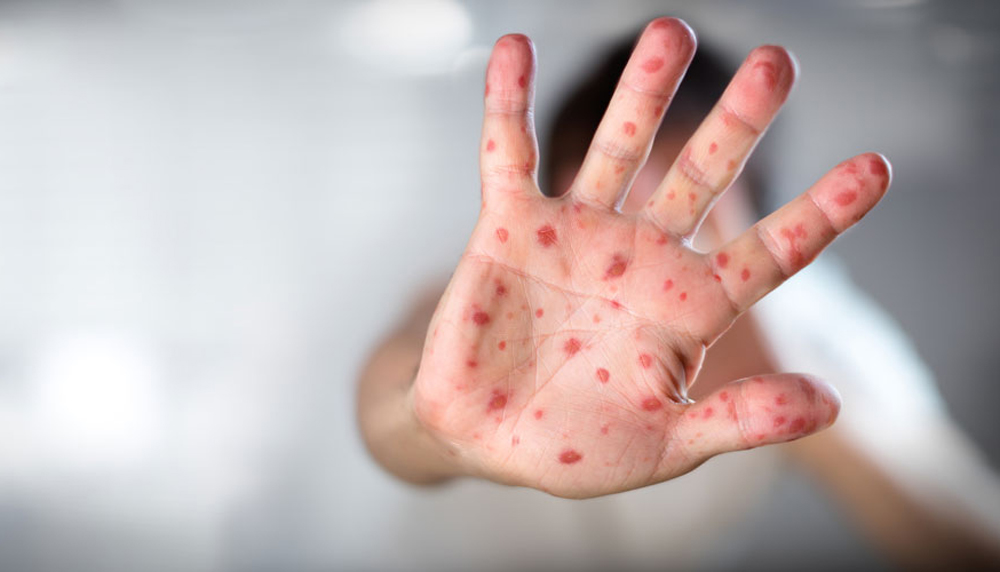 С 2026 года дети будут получать полную защиту от кори в более раннем возрасте