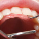 Правительство расширило программу безвозмездного зубопротезирования для пострадавших от аварии на ЧАЭС