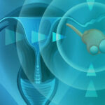 Препарат от Corcept для лечения рака яичников получил одобрение FDA