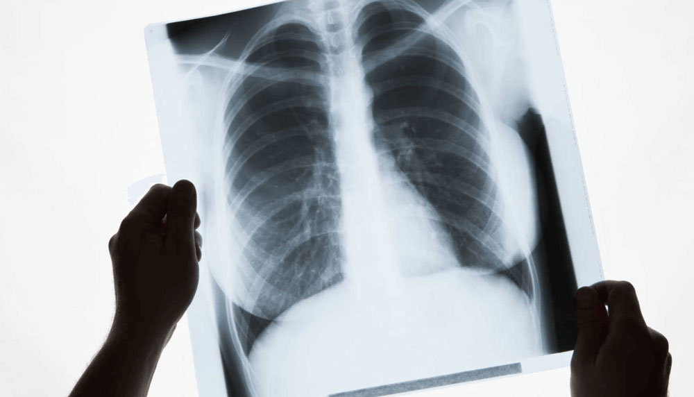 Снова более 1000 случаев туберкулеза в месяц зафиксировано в Украине